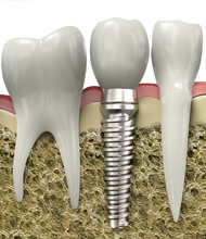 <h4>Implantes</h4>Destinado a ser el sustituto artificial de la raíz de un diente perdido, fabricados con materiales que no producen reacción. no desgasta dientes vecinos.