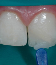 <h4>Restauraciones Estéticas</h4>Resinas, Incrustaciones libres de metal, Coronas y Carillas (Libres de Metal)