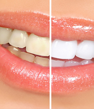 <h4 4>Blanqueamiento</h4>Tratamiento estético para lograr reducir tonos el color original de las piezas dentales, dejando los dientes más blancos y brillantes.