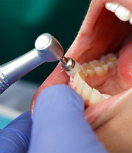 <h4>Profilaxis Limpieza con Ultrasonido</h4>Procedimiento de mayor importancia para la prevención de algunas enfermedades y alteraciones de carácter bucal.